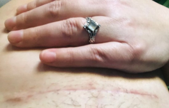 cesarean scar